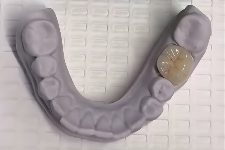 Intra Oral Scanning