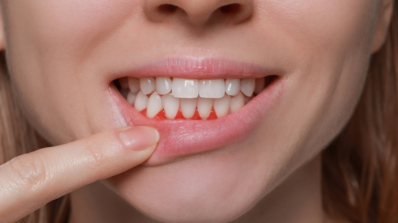 Gum disease treatment