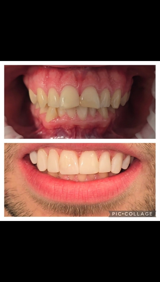 Composite Bonding