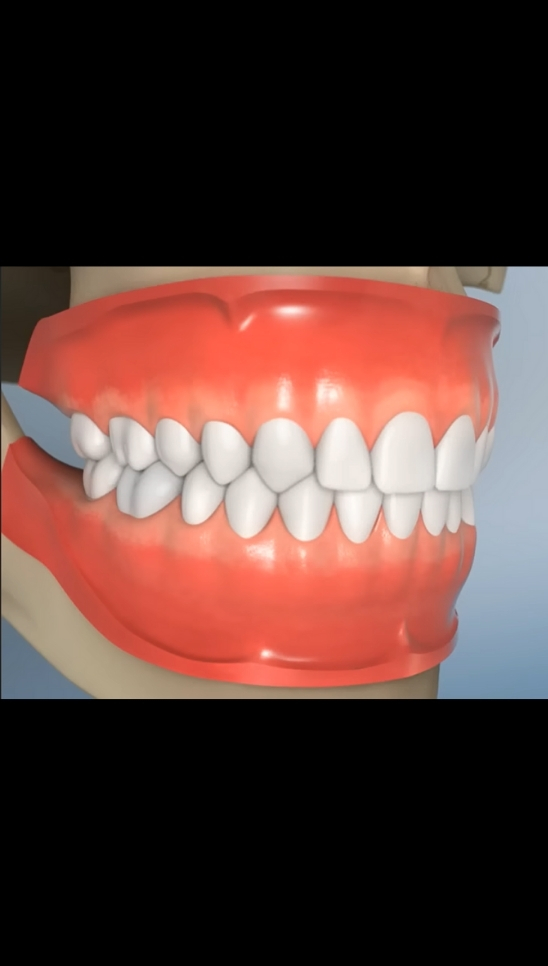 White fillings